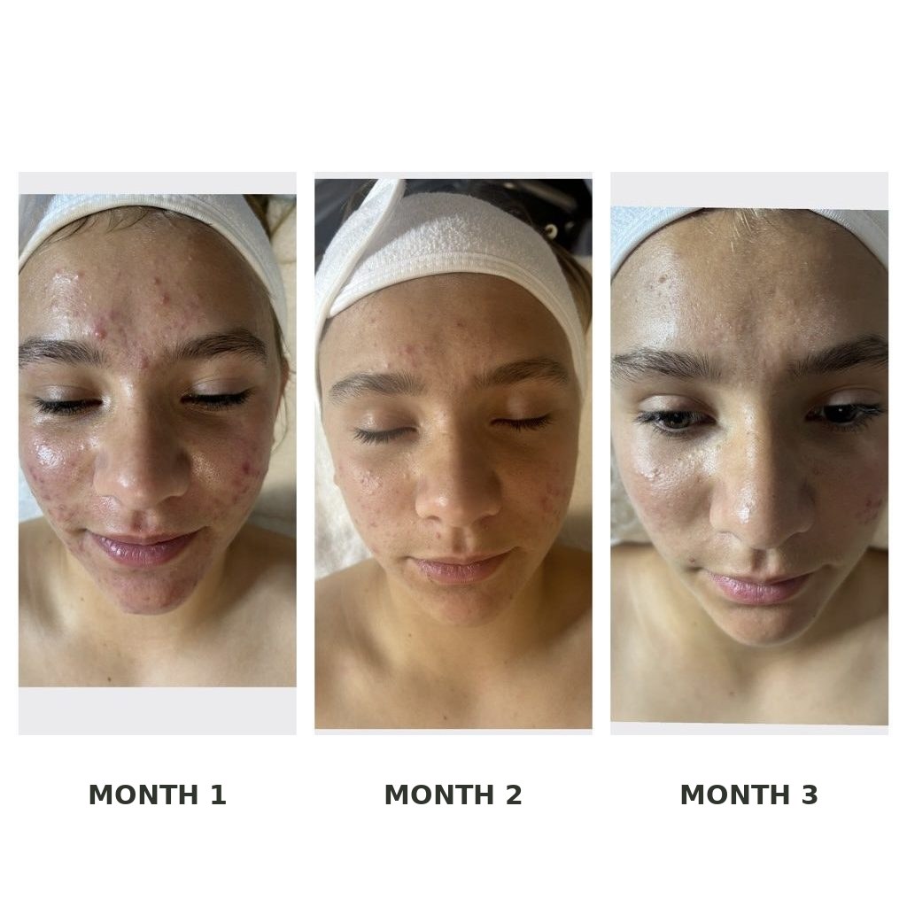 A teenage guest's acne clearing across three months of her facial plan