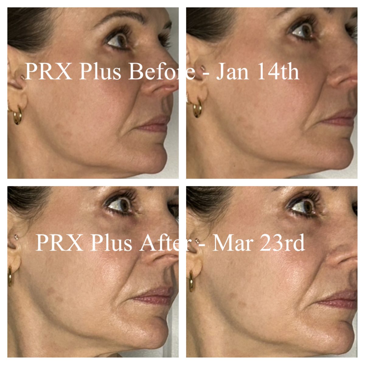 A guest before PRX Plus in January and after in March — smoother, more even skin