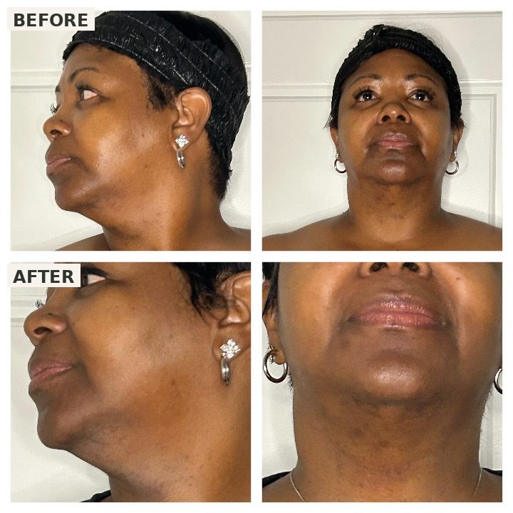 A guest's chin and jawline from two angles — before PRX Plus on the top row, the more even tone after on the bottom