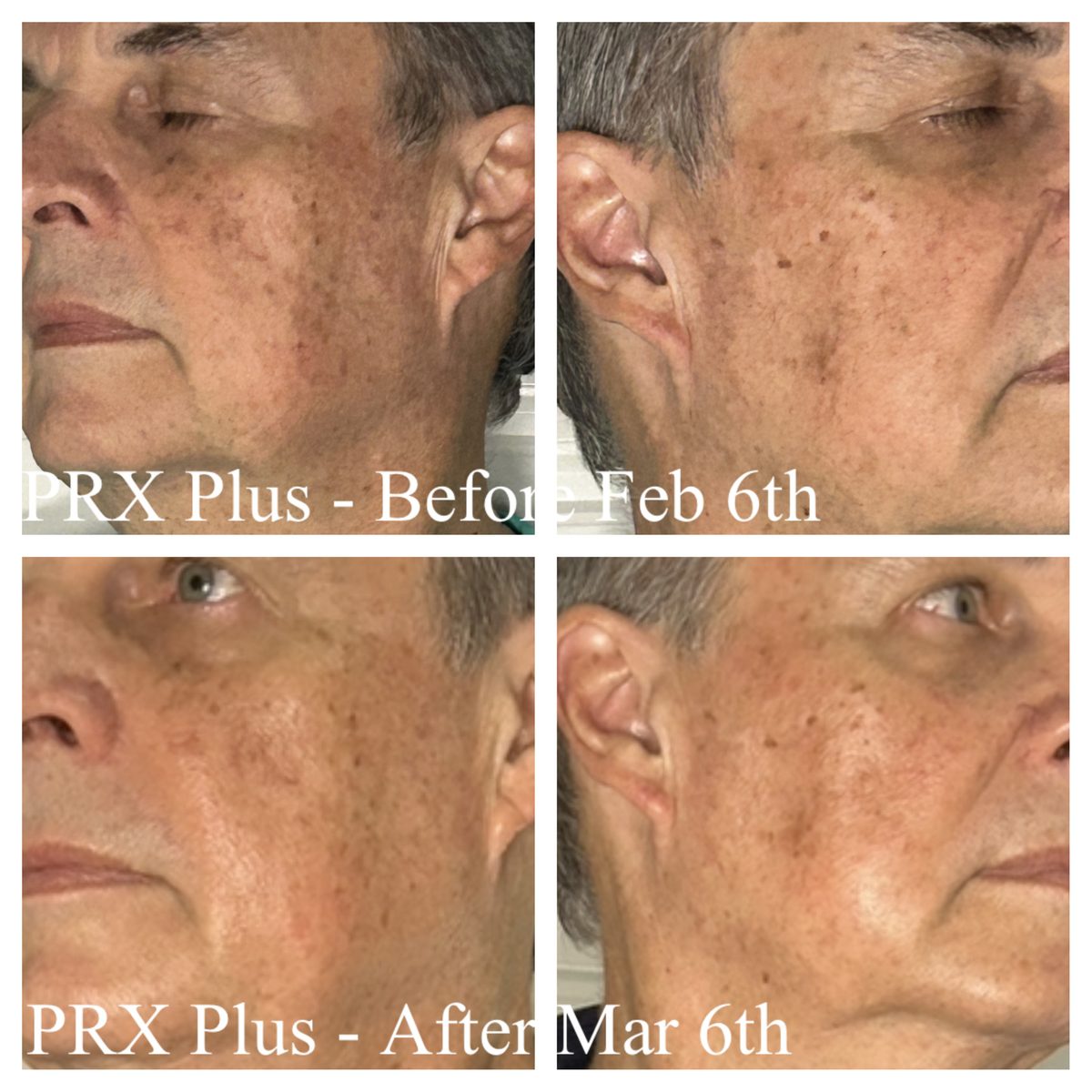 A Rejuva Haven guest's cheek and jaw before PRX Plus in February and after in March, with softened texture