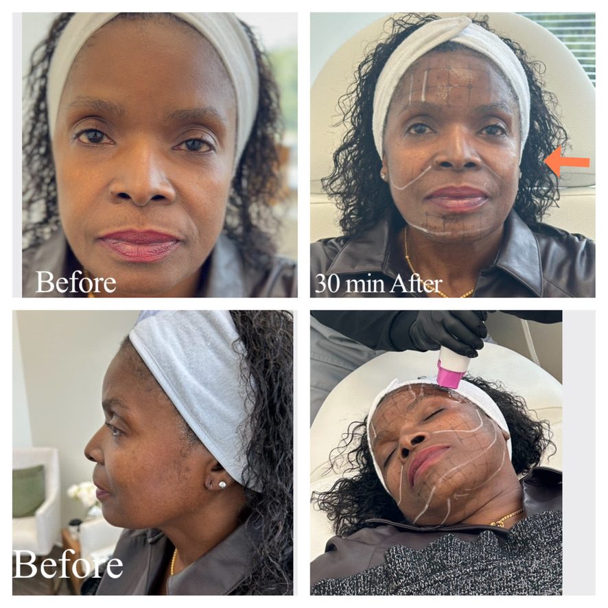 A guest before Thermage FLX and 30 minutes after treatment