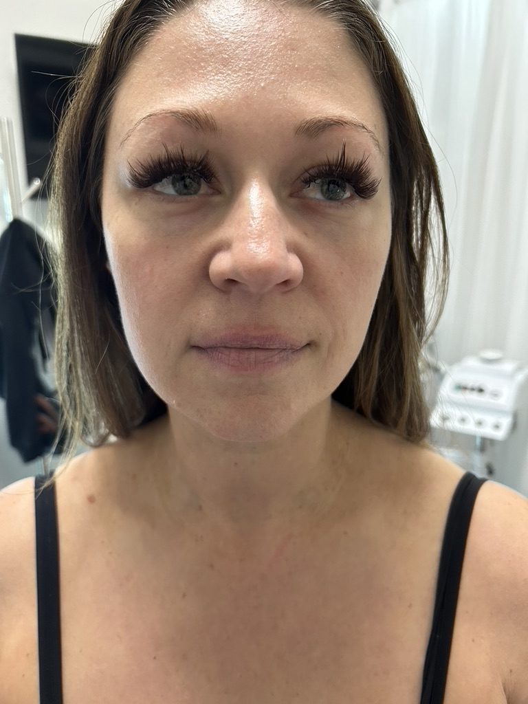 A Rejuva Haven guest's smooth, even skin after her Thermage FLX session